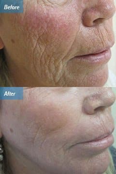 before & after image of laser skin resurfacing