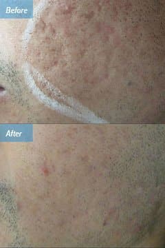 Even one treatment alone can<br> significantly improve unwanted acne<br> scars.