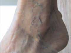 foot veins to be treated with sclerotherapy