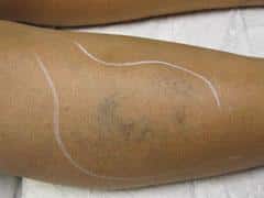 Untreated leg veins with matting<br> (clustering of veins).