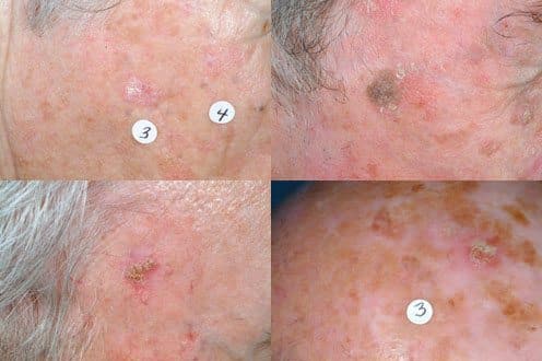 Signs of Actinic keratoses