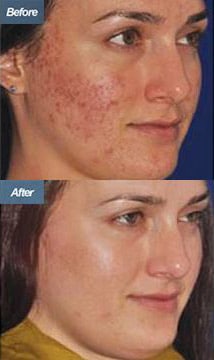 Before & After Micro-Needling<br> treatment