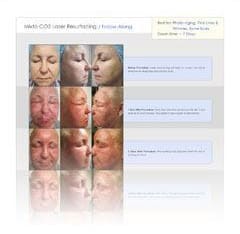 screenshot of the Mixto CO2 Laser Resurfacing follow-along guide