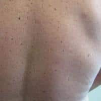 image showing benign moles on someone's back