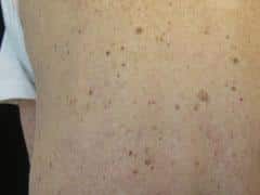 image of someone's skin showing several benign moles next to suspicious moles