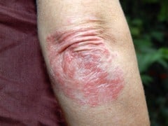 Plaque psoriasis in a typical distribution on elbows.