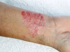 Plaque psoriasis on wrist