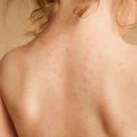 woman's back with small bumps all over it