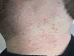 Localized rash caused from contact<br> with allergen.
