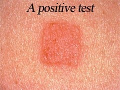 skin_allergy_testing-3
