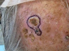 Basal Cell Carcinoma of forehead.