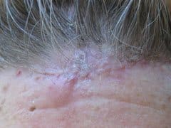 Squamous Cell Carcinoma of<br> forehead.