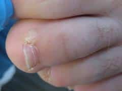 untreated wart on the toe