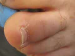 image of toe after wart treatment