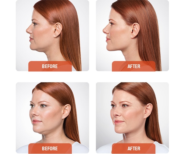 Kybella Results