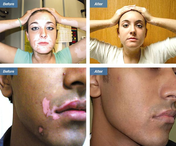 woman's face before and after excimer treatment