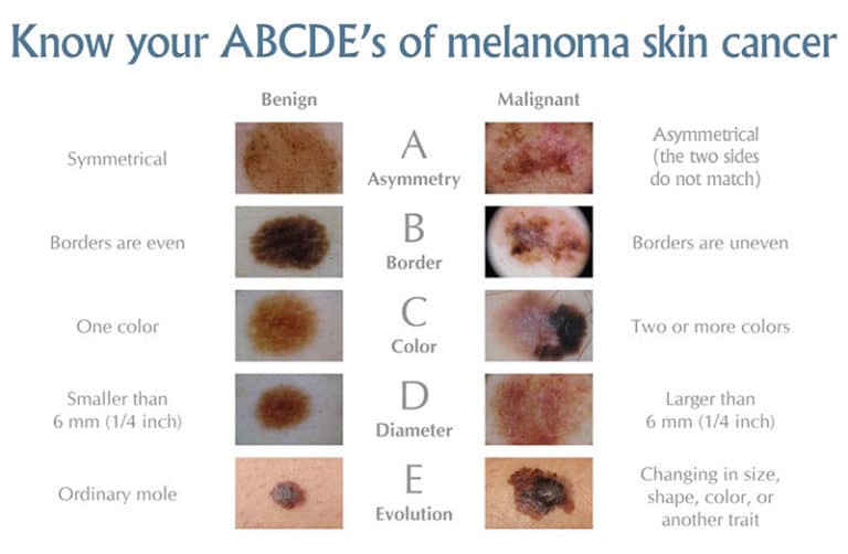 Skin Cancer Check Burbank CA Skin Cancer Exam Glendale CA