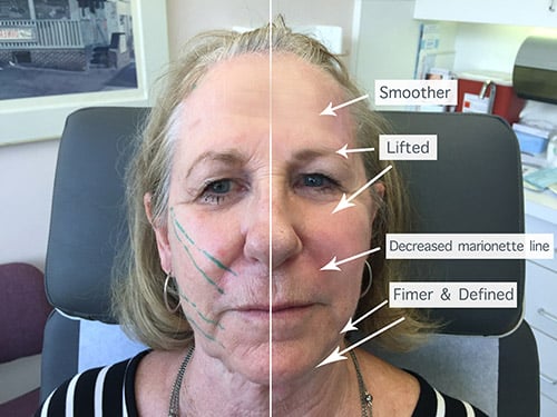 How Much Does A Pdo Thread Lift For Cheeks Cost