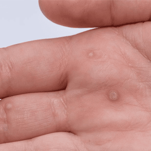 Wart on hand