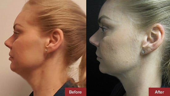 Kybella Results