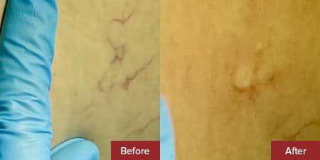 Sclerotherapy results