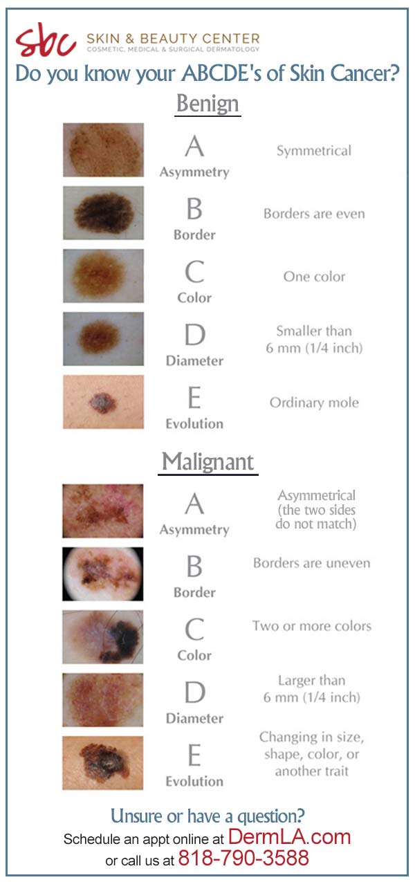 ABCDE of Skin Cancer