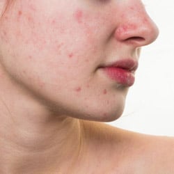 Acne scares on face