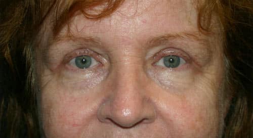 After Eyelid Surgery