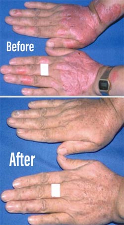 Excimer Laser Therapy Results