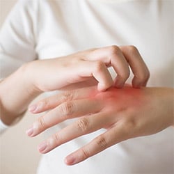 Eczema Treatment