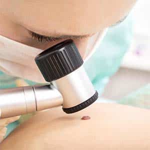 Melanoma Treatment