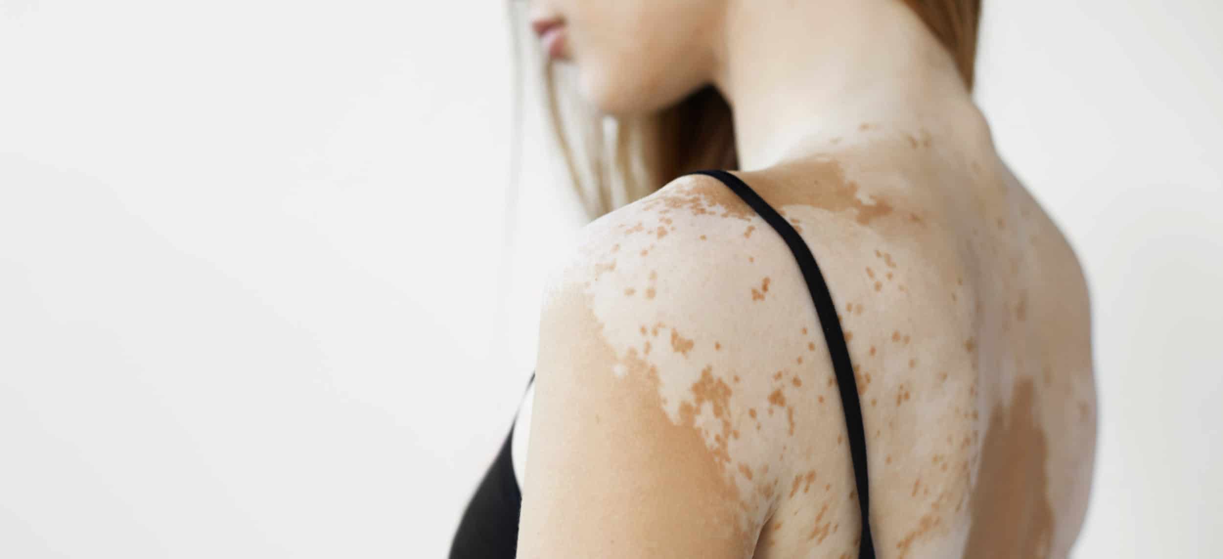 Vitiligo