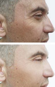 male eyes wrinkles before and after botox injection treatment.