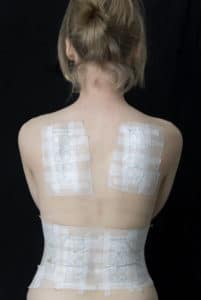 A woman undergoing patch testing to check for allergic reactions on the skin.