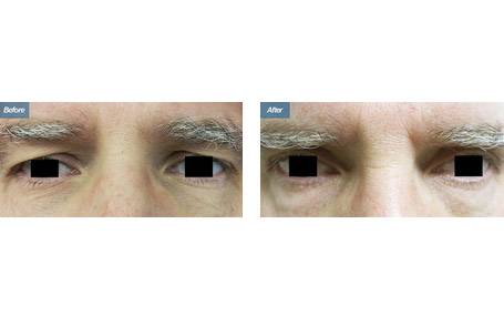 ba-eyelid-surgery