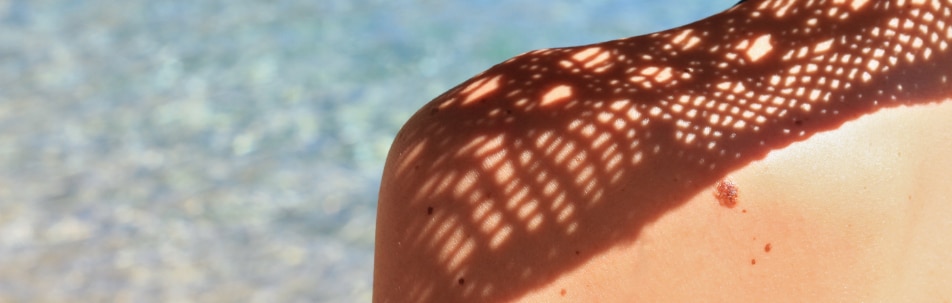 image of shoulder with sun spots on it