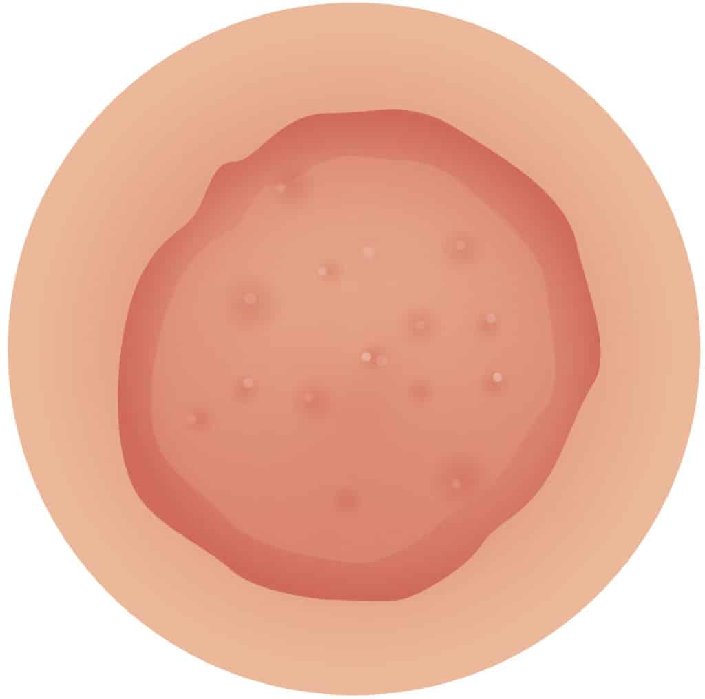 iStock 1126111641 eczema 1024x1015 1