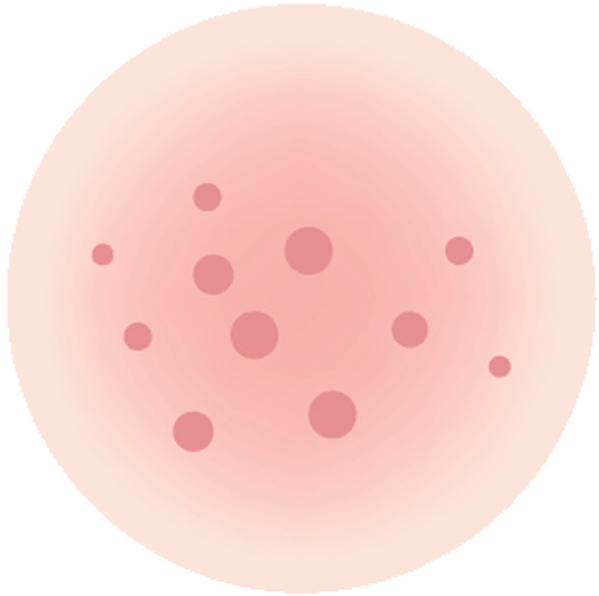 iStock 614021632 melasma