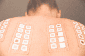 Alergy patch test on the back of a young woman