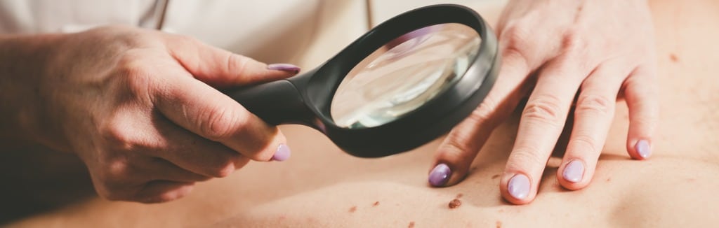 dermatologist examining moles on the skin of a patient with a magnifying glass