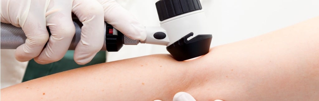 dermoscopy on woman's arm - squamous cell carcinoma burbank