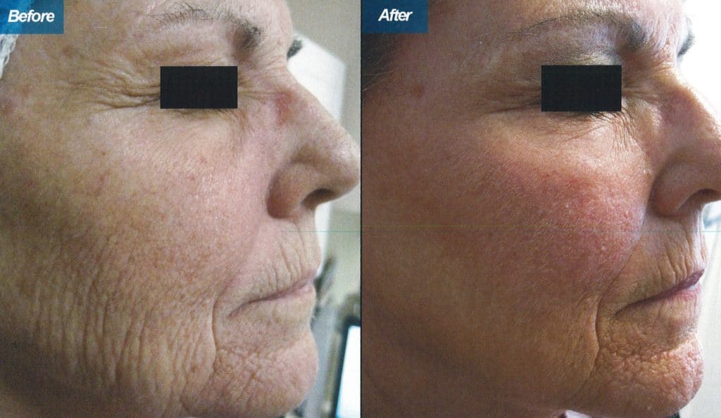 1 Treatment Fine Lines Around Eyes and Cheeks 1