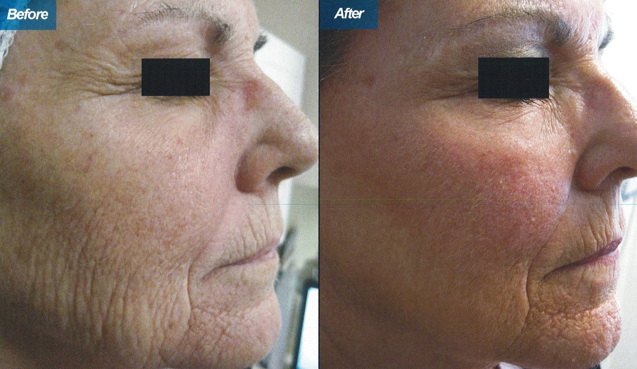 C02 Laser Resurfacing in Northridge Wrinkle & Scar Reduction Burbank