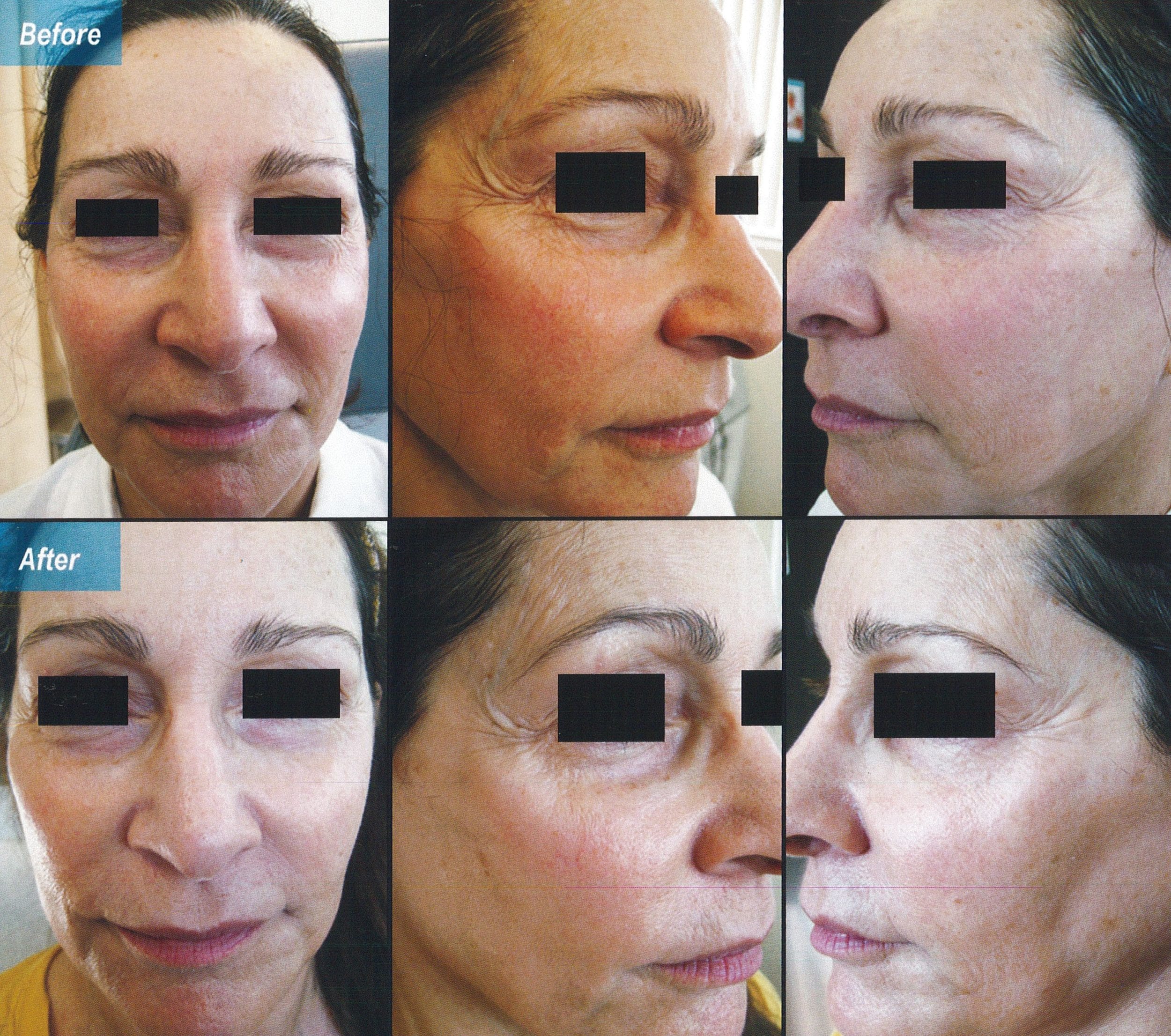 female patient before and 3 Weeks after chemical peel, with clearer skin after