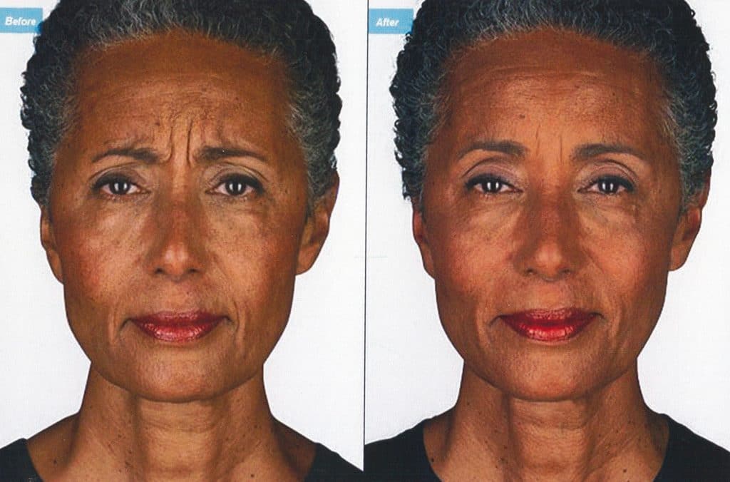 Botox before & after image on the Forehead