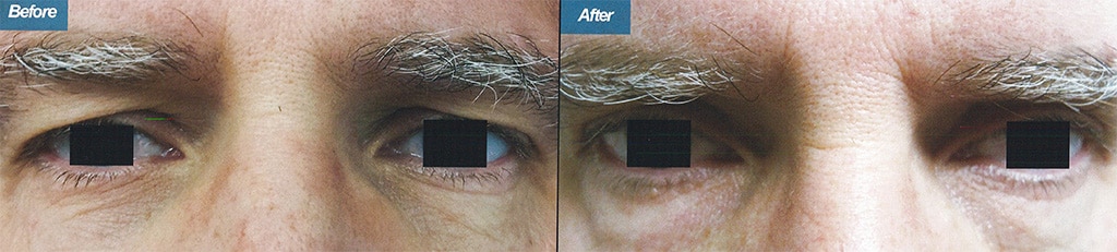 Eyelid Surgery