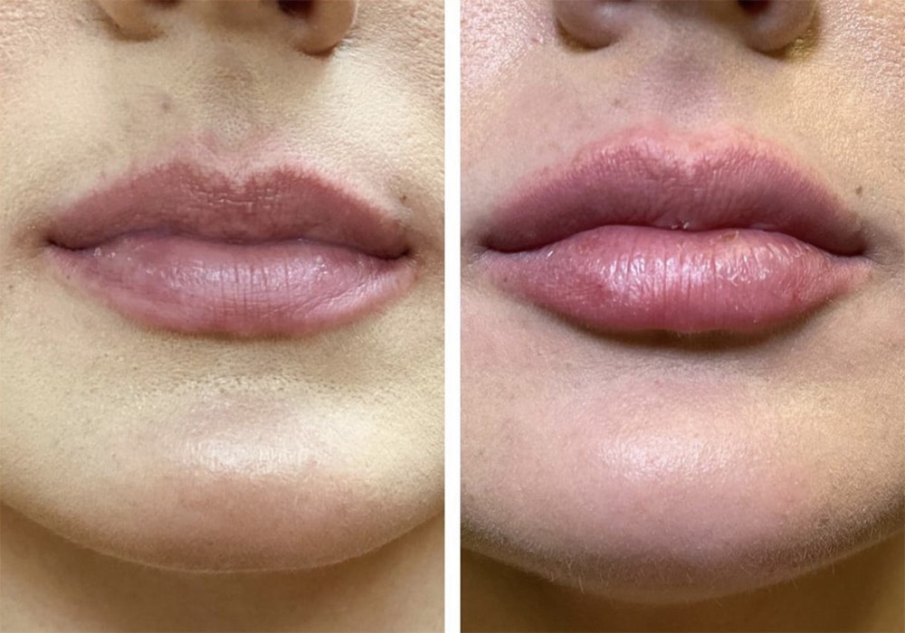 Lip Augmentation