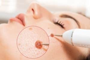 Dermatologist using a professional electrocautery for removing mole