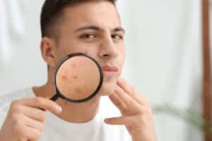 young man with acne problem and magnifier at home