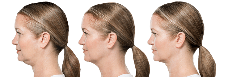 SKIN & BEAUTY CENTER KYBELLA